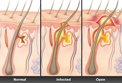 skin illustration - boil